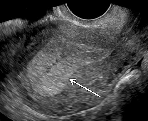 thick endometrial lining positive pregnancy test|endometrial thickness ultrasound.